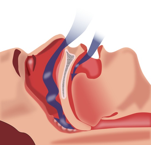 Apnea Detection from Tracheal Sounds using ResNet